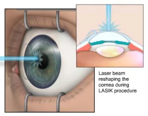 cheap-lasik-surgery-abroad